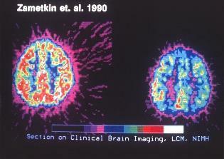 klinické skenování mozku pro adhd