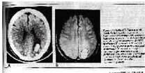 Intracerebrální krvácení po elektrokonvulzivní terapii (ECT)