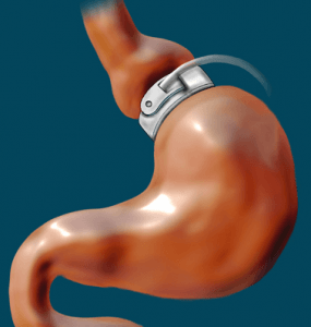 Lap-Band je jedním z příkladů jednoho druhu žaludeční chirurgie, kterou lze použít k léčbě poruch příjmu potravy.