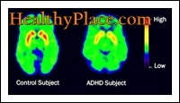Pojmy ADD a ADHD byly použity zaměnitelně. Aktualizovaný termín je však podle DSM IV ADHD (Attention Deficit Hyperactivity Disorder).